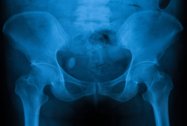 URINARY BLADDER STONES SURGERY